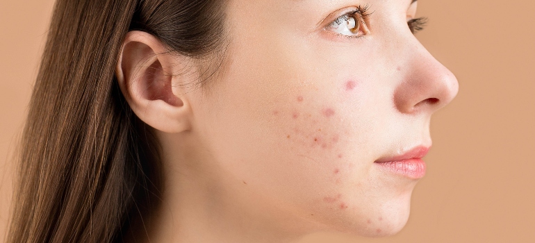 acne as one of the dangers of improper substance detoxification in PA