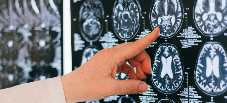 doctor pointing to an image of a brain