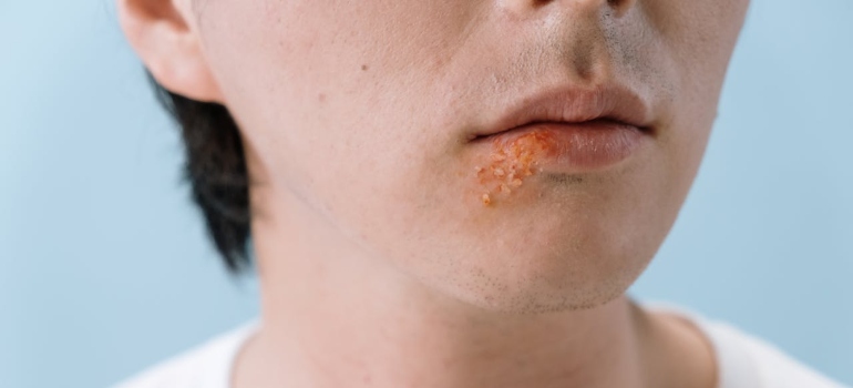 Skin disease on person's face