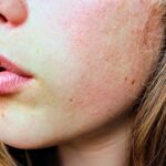 a girl's face as a symbol of link between drugs and skin sores