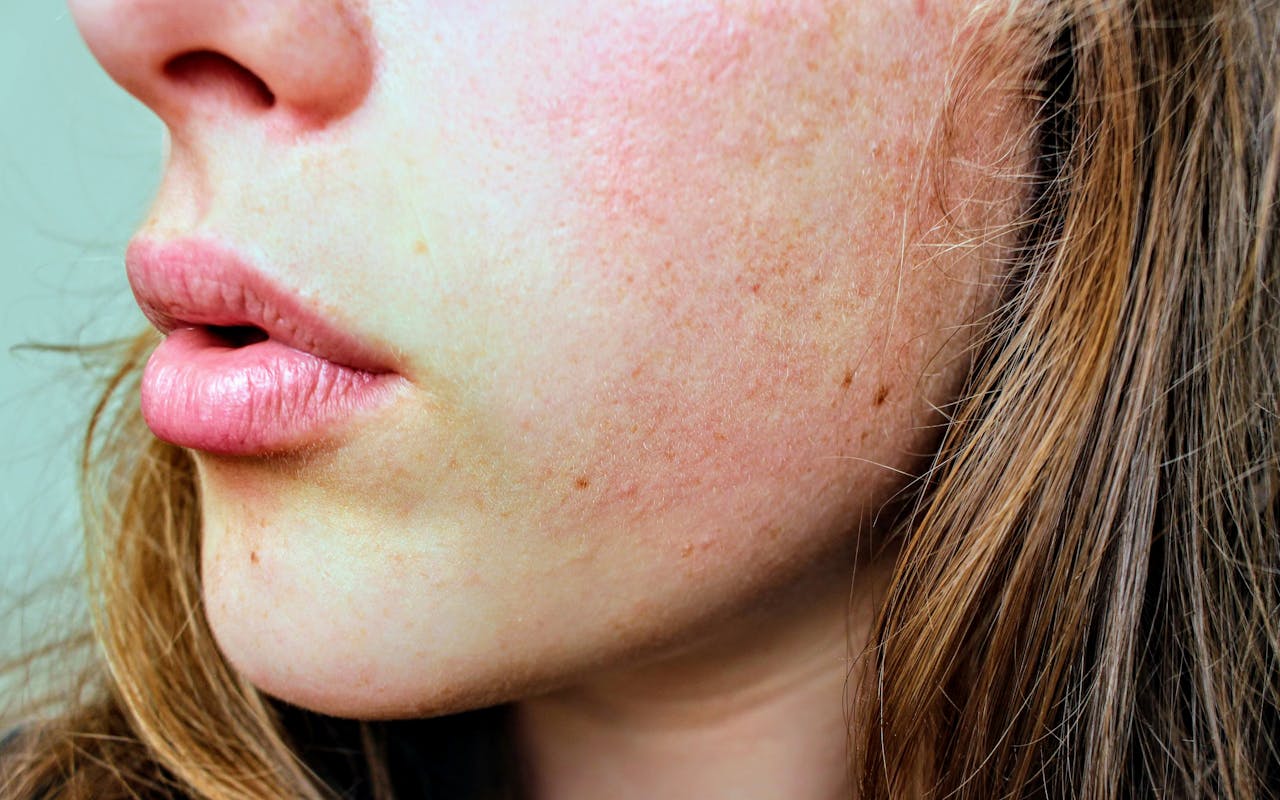 a girl's face as a symbol of link between drugs and skin sores