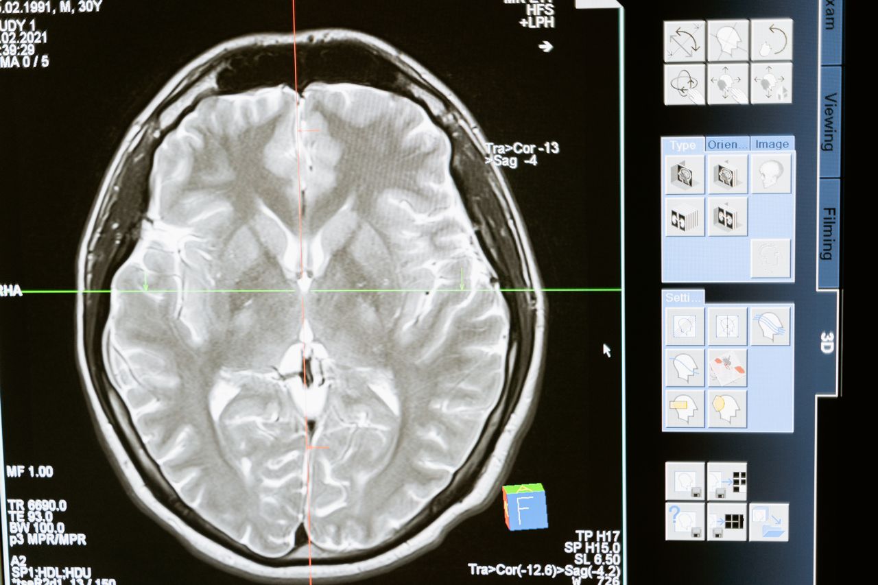 MRI image of a brain.